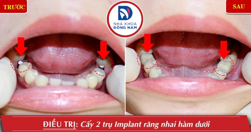 trồng implant 2 răng số 6 hàm dưới