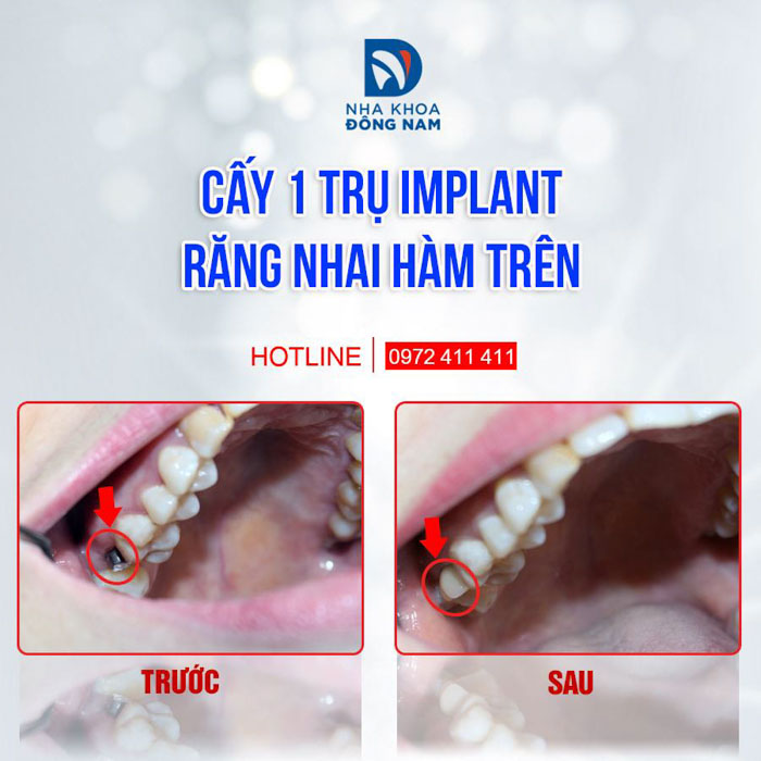 Răng Implant khôi phục ăn nhai thẩm mỹ như răng thật