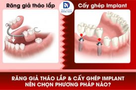 Cấy Ghép Răng Implant