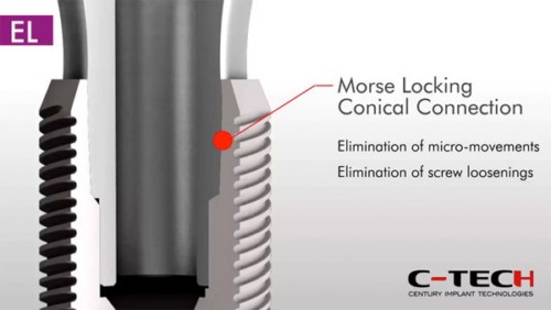 cấu tạo implant ý
