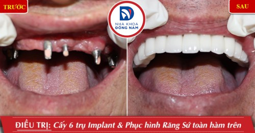 cấy ghép implant toàn hàm trên