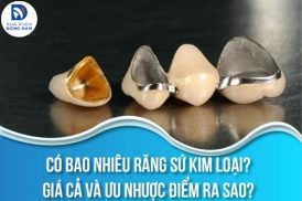 Có bao nhiêu răng sứ Kim Loại? Giá cả và ưu nhược điểm ra sao?