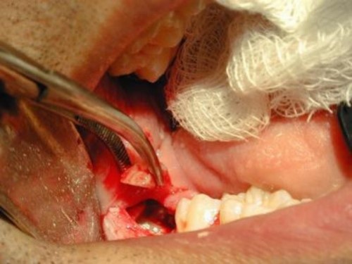 quá trình nhổ răng