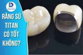 Răng sứ TITAN là răng sứ thế nào? Có tốt không? Giá bao nhiêu?