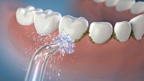 Vôi răng là gì tác hại của vôi răng 12