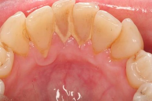 Vôi răng là gì tác hại của vôi răng 2