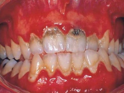 Vôi răng là gì tác hại của vôi răng 5