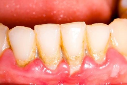 Vôi răng là gì tác hại của vôi răng 6