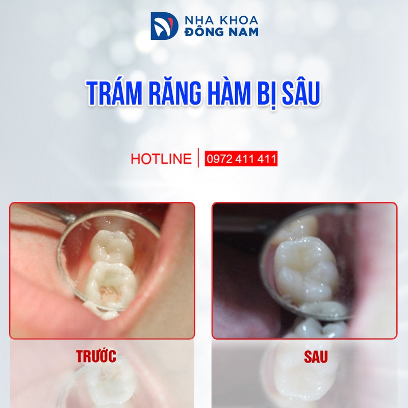 Trường hợp trám răng hàm bị sâu