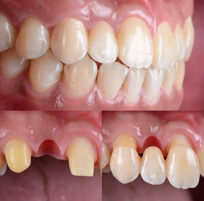 Cầu răng sứ giúp khôi phục thẩm mỹ cao