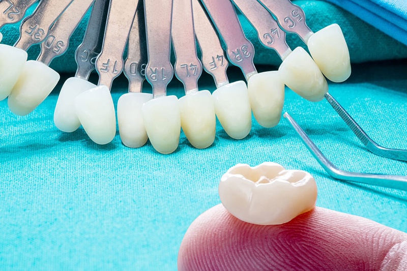 Chi phí cầu răng sứ ảnh hưởng nhiều yếu tố