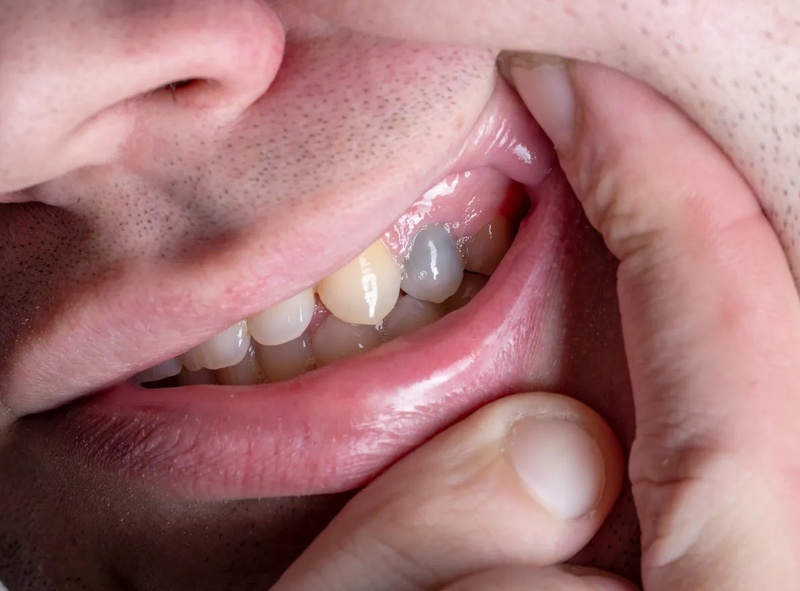 Chi phí chữa tủy răng nanh thường thấp hơn so với răng hàm