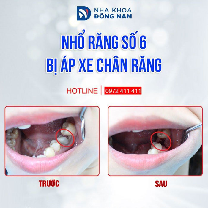 Hình ảnh thực tế một ca nhổ răng số 6 bị áp xe nặng