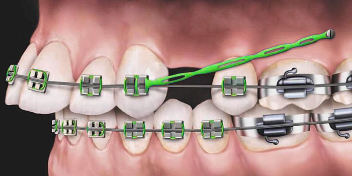 Một số trường hợp niềng răng cần nhổ răng để tạo khoảng trống