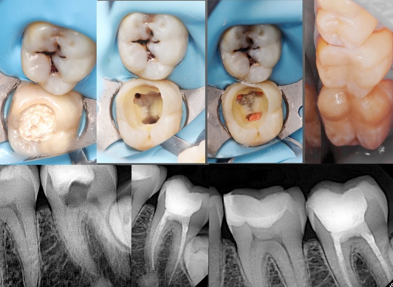 Răng chữa tủy giúp khôi phục ăn nhai và thẩm mỹ