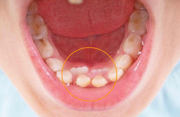 Răng sữa không rụng nhưng răng vĩnh viễn mọc lên cần phải được nhổ bỏ sớm