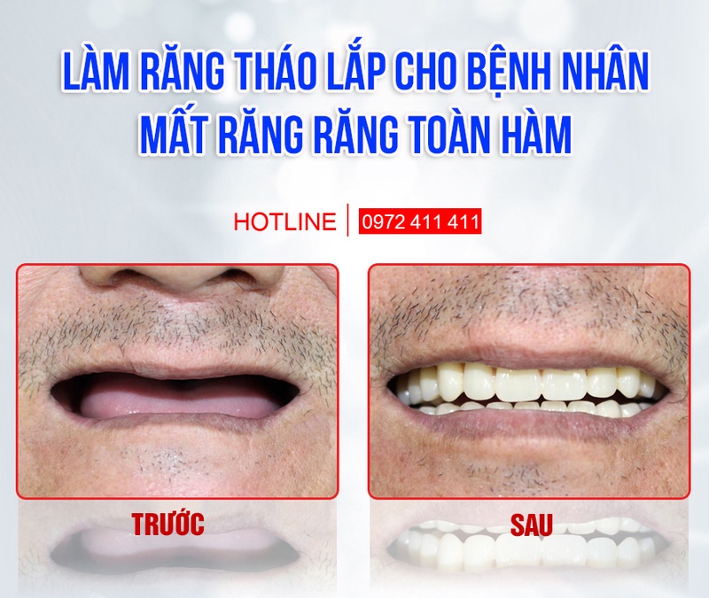 Răng tháo lắp giúp cải thiện ăn nhai ở mức cơ bản
