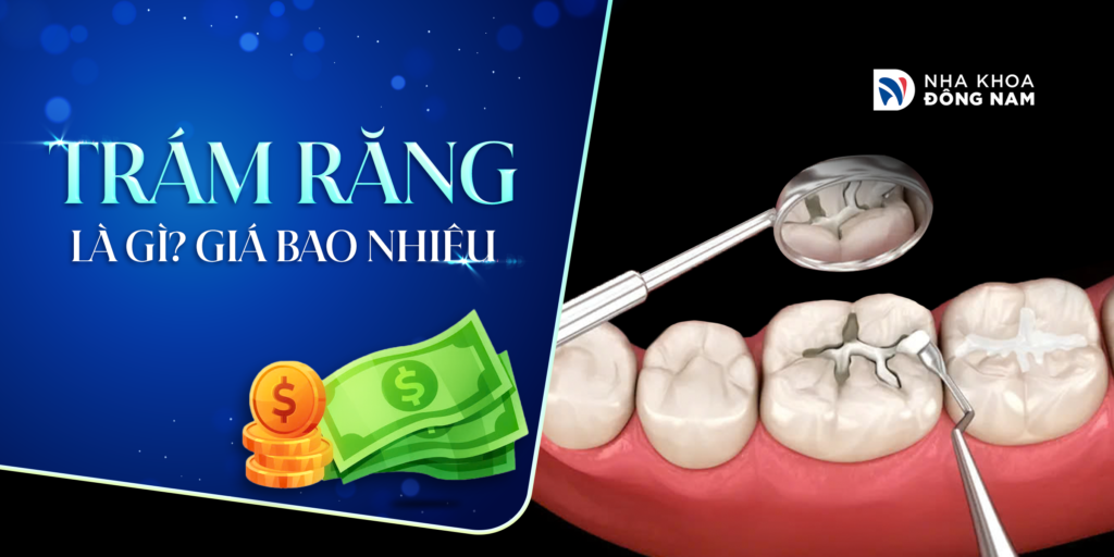 Trám răng là gì giá bao nhiêu