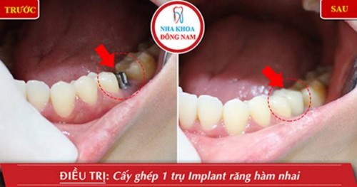 Lưu ý trồng răng Implant cho bệnh nhân ở xa 10