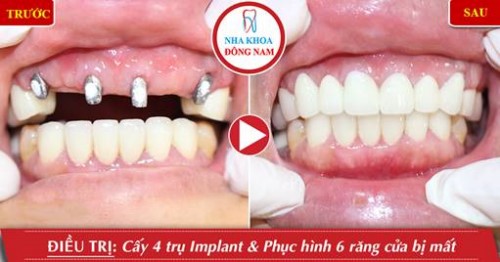 Lưu ý trồng răng Implant cho bệnh nhân ở xa 11