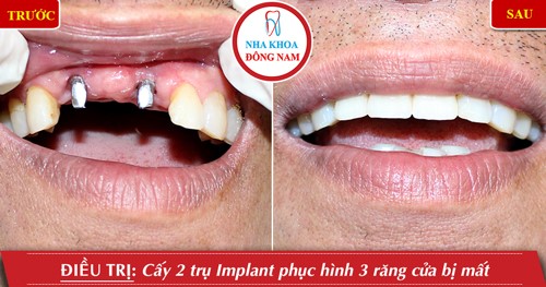 Lưu ý trồng răng Implant cho bệnh nhân ở xa 12