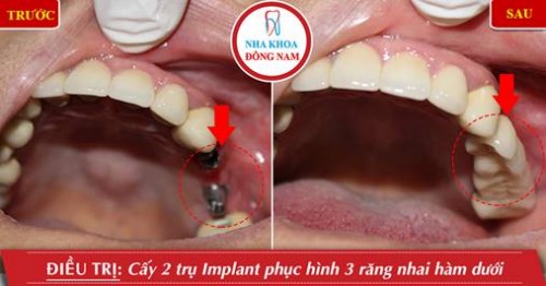 Lưu ý trồng răng Implant cho bệnh nhân ở xa 14