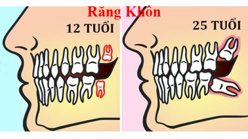 độ tuổi mọc răng khôn