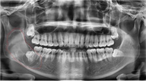 chụp phim ct kiểm tra răng khôn