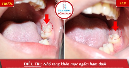 nhổ răng khôn tại nha khoa đông nam