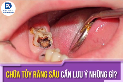 Chữa tủy răng sâu cần lưu ý những gì?