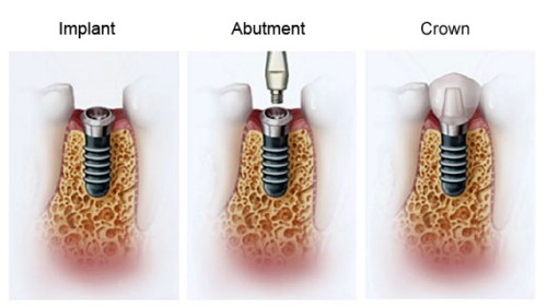 kỹ thuật cấy ghép implant