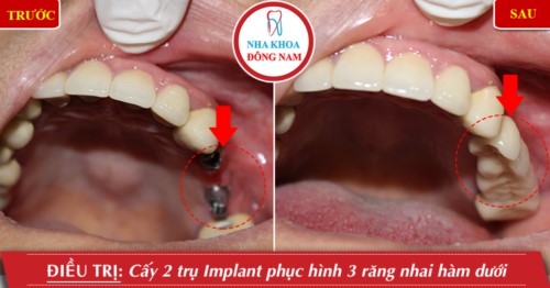 trồng 2 trụ implant răng nhai hàm trên