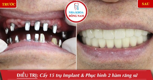 cấy ghép implant toàn hàm