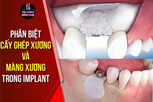 Phân biệt cấy ghép xương và màng xương trong implant