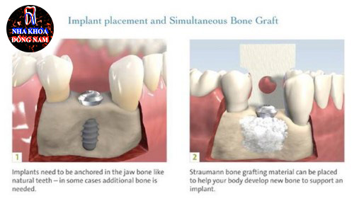 Phân biệt cấy ghép xương và màng xương trong implant