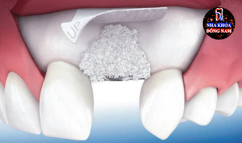 Phân biệt cấy ghép xương và màng xương trong implant 4