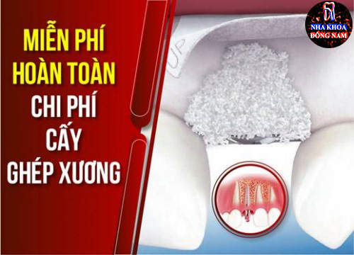 Phân biệt cấy ghép xương và màng xương trong implant 8