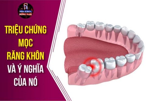 Triệu chứng mọc răng khôn và ý nghỉa của nó