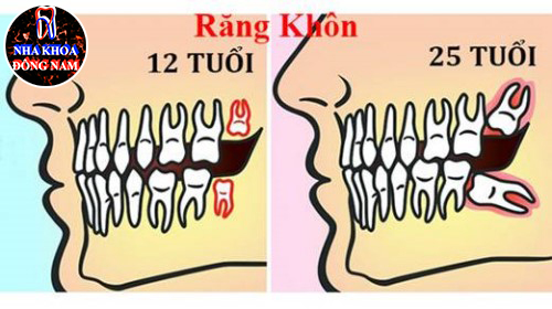 Triệu chứng mọc răng khôn và ý nghỉa của nó 2