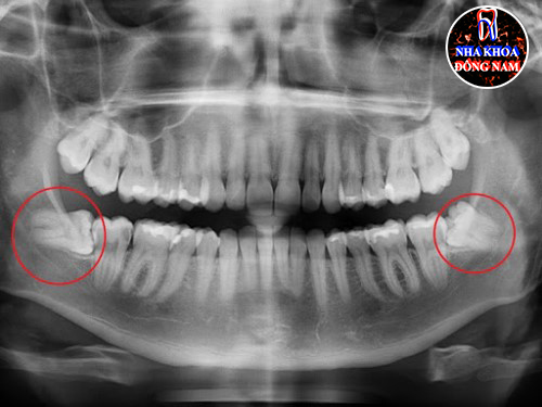 Triệu chứng mọc răng khôn và ý nghỉa của nó 5