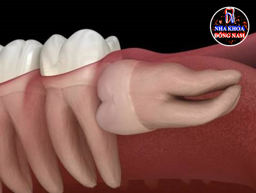 Triệu chứng mọc răng khôn và ý nghỉa của nó 6