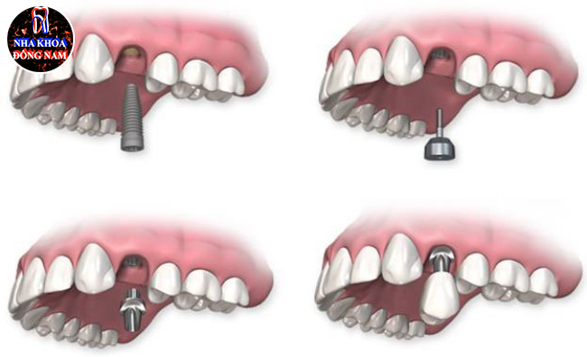 Trồng răng cho người trung niên và những điểm cần lưu ý 2