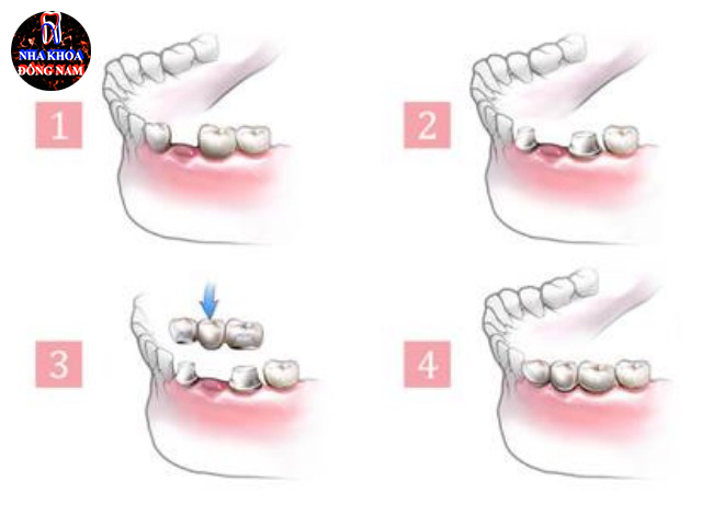 Trồng răng cho người trung niên và những điểm cần lưu ý 3