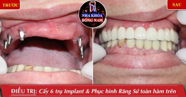 Trồng răng cho người trung niên và những điểm cần lưu ý 8