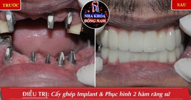 Trồng răng cho người trung niên và những điểm cần lưu ý 8