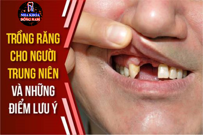 Trồng răng cho người trung niên và những điểm cần lưu ý