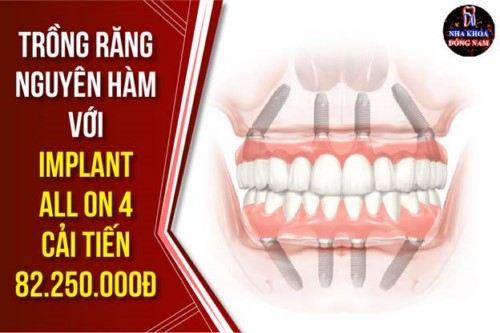 Trồng răng nguyên hàm với Implant all on 4 cải tiến