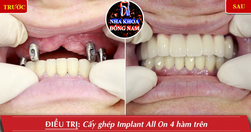 Trồng răng nguyên hàm với Implant all on 4 cải tiến 6