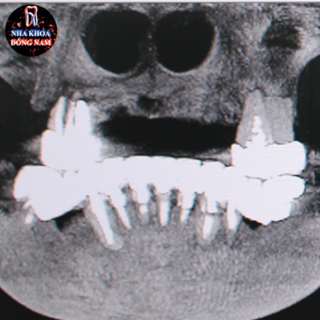  cấy ghép implant thay thế cầu răng sứ 2 hàm bị hỏng 1