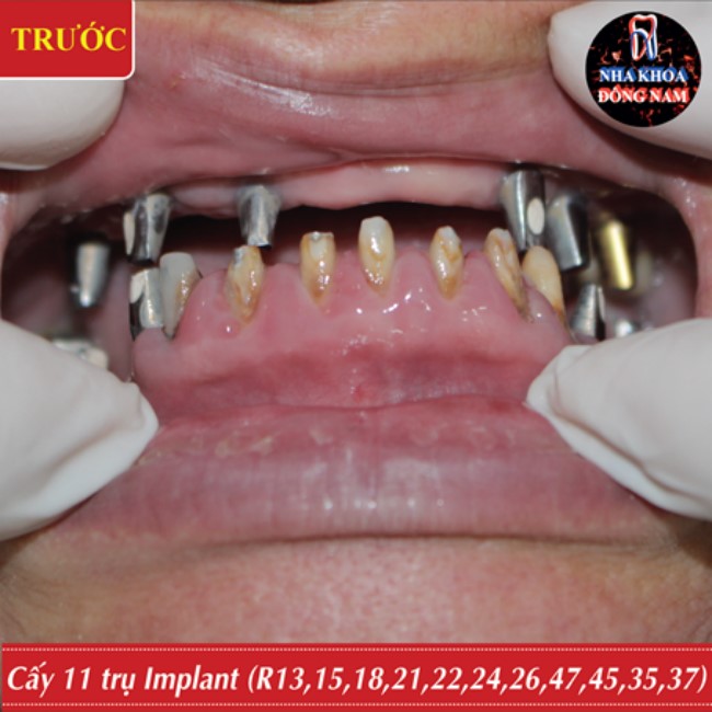 cấy ghép implant thay thế cầu răng sứ 2 hàm bị hỏng 5